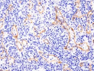 Dedifferentiation: IHC analysis using N-Cadherin antibody. The Cadherin Switch can help identify EMT.