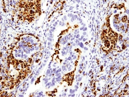 Blocked Differentiation: IHC analysis using MPO antibody, a biomarker used to monitor differentiation status in AML.