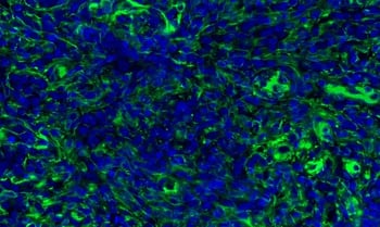 Dedifferentiation: Multiplex IHC analysis using vimentin antibody, which can be used to identify epithelial-mesenchymal transition (EMT).