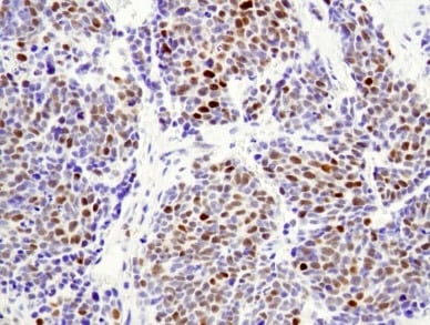 Blocked Differentiation: IHC analysis using N-Myc antibody.