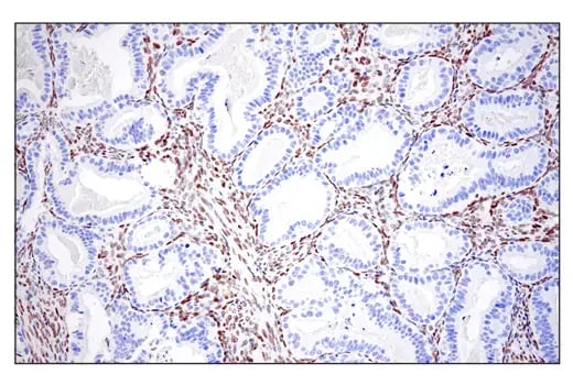 IHC analysis of human endometrioid adenocarcinoma using ZEB1 antibody