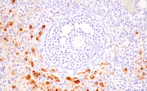 88742_IHC analysis using osteopntin SPP1 antibody