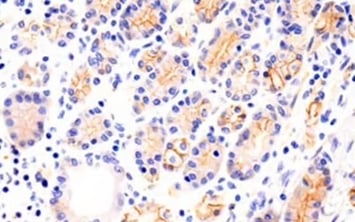 IHC analysis of gastric cancer using N-Cadherin antibody, an EMT marker