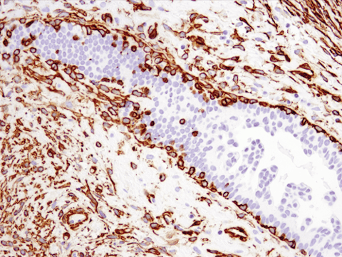 IHC analysis of breast cancer using α-Smooth Muscle Actin antibody, an Epithelial-Mesenchymal Transition marker