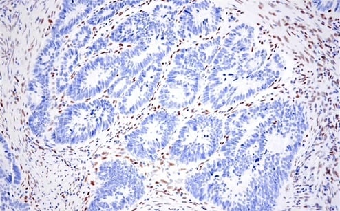 IHC analysis of colon cancer using ZEB1 antibody, an EMT regulator