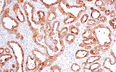 IHC analysis of ovarian clear cell carcinoma using occludin antibody, an EMT marker