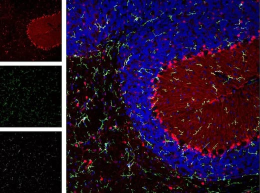 Multiplex IF Chimeric_Alzheimers CD11b S100B HS1