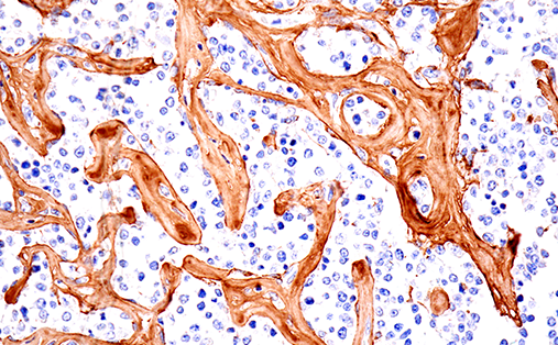 66948_IHC B cell non-Hodgkins lymphoma_fibrosis using COL1A1 Antibody