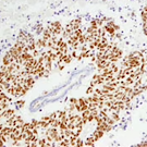 BAF Sampler kit thumbnail_ARID1A_BAF250A lung cancer