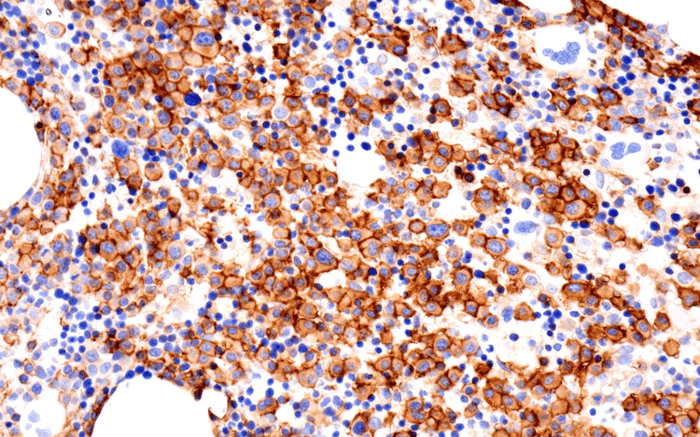 CD38 Recombinant Antibody Multiple Myeloma IHC