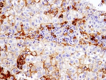 CST13684_PD-L1 Lung cancer biomarker