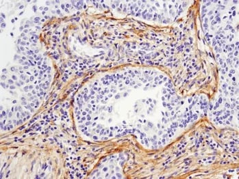 IHC analysis of paraffin-embedded human cervical carcinoma using MMP-2 antibody.