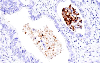 IHC analysis of human endometrioid adenocarcinoma using IL-8 antibody to detect the SASP factor IL-8.