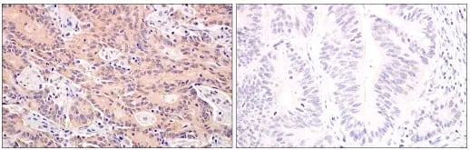 IHC analysis of B-Raf V600E mutant positive human colon carcinoma (left) and human colon carcinoma (right) using B-Raf V600E antibody.