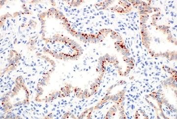IHC analysis of human lung cancer using ROS1 monoclonal antibody.