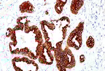 IHC analysis of human lung carcinoma using ALK monoclonal antibody.