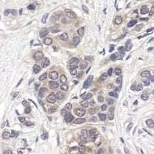 IHC analysis of human breast cancer using p4442 MAPK antibody.