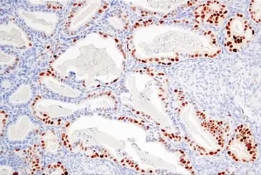 IHC analysis of human endometrioid cancer using Cyclin D1 antibody.