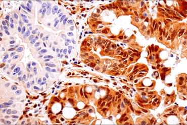 IHC analysis of human esophageal cancer using PTEN antibody.