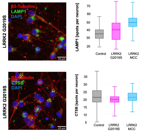 Multiplex immunofluorescence images of lysosomal proteins LAMP1 and Cathepsin B (CTSB) in iCell DopaNeurons, including healthy control, LRRK2 G2019S mutant, and mutation-corrected control cells, with accompanying quantification of lysosomal spots per neuron across conditions.