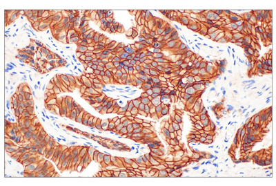 IHC analysis of beta-catenin antibody in paraffin-embedded human prostate cancer tissue.