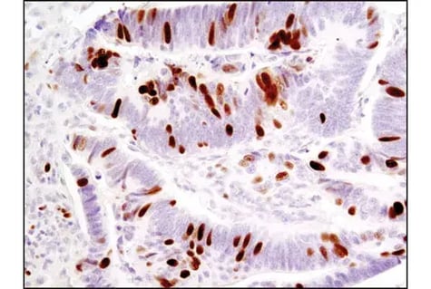 IHC analysis of phospho-Rb protein in paraffin-embedded human colon cancer tissue.
