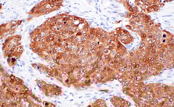 IHC analysis of paraffin-embedded human ovarian serous papillary carcinoma using p16 INK4A (F9T1L) Rabbit Monoclonal Antibody #88667.