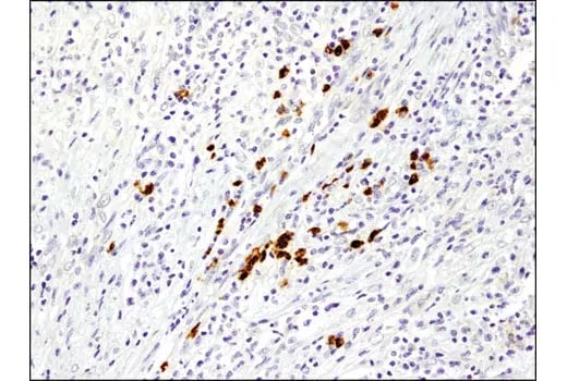 IHC analysis of paraffin-embedded human breast carcinoma using MMP-9 (D6O3H) Rabbit Monoclonal Antibody #13667