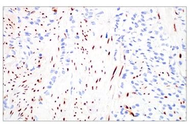 IHC analysis of paraffin-embedded human prostate adenocarcinoma using Basic FGF (E5Y6M) Rabbit Monoclonal Antibody #46879 highlights FGF expression by tumor cells.