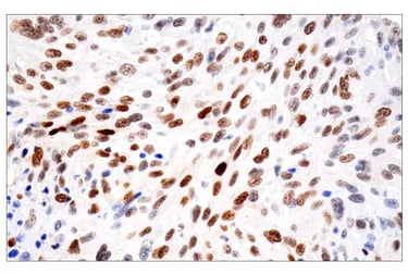 Immunohistochemical (IHC) analysis of paraffin-embedded human gastrointestinal stromal tumor using HIF-1α (E1V6A) Rabbit Monoclonal Antibody #48085 performed on the Leica BOND™ Rx.