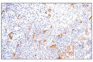 IHC analysis of paraffin-embedded human urothelial carcinoma using CD54/ICAM-1 (E3Q9N) Rabbit Monoclonal Antibody #67836 performed on the Leica BOND&nbsp;RX.