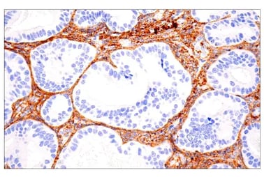 IHC analysis of paraffin-embedded human endometrioid adenocarcinoma using COL1A1 (E8F4L) Rabbit Monoclonal Antibody #72026 performed on the Leica BOND RX.