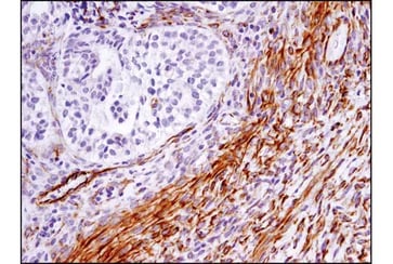 IHC analysis of paraffin-embedded human ovarian carcinoma using SDF1/CXCL12 (D8G6H) Rabbit Monoclonal Antibody #97958.