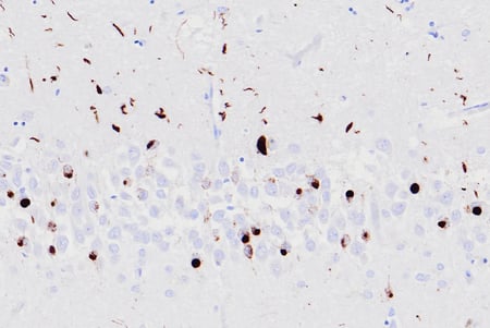 Immunohistochemical analysis of paraffin-embedded human hippocampal brain tissue with TDP43 proteinopathy using Phospho-TDP43 (Ser409/Ser410) (F9S3F) Rabbit Monoclonal Antibody #77613.
