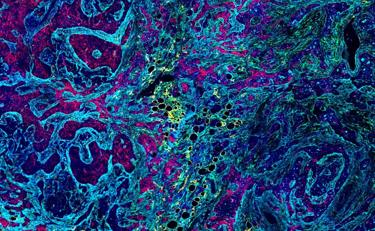 SignalStar® Multiplex IHC panel in infiltrating ductal carcinoma of the breast, illustrating a mid‑plex approach using four markers for tumor, stroma, and microenvironment targets to create a single interpretable dataset.