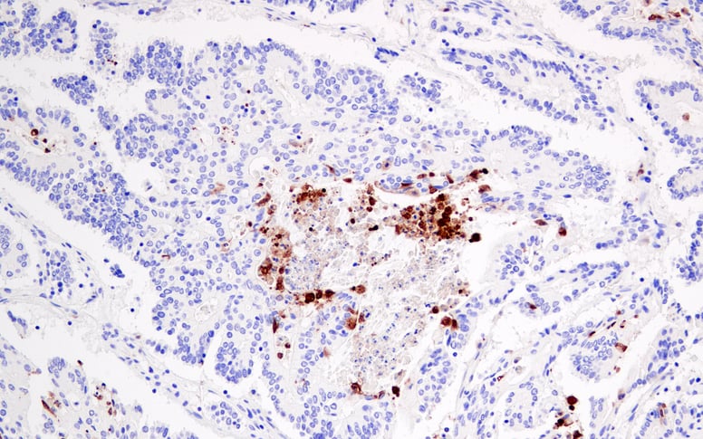 IHC Colon