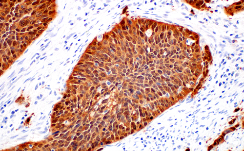IHC analysis of human squamous cell carcinoma of the cervix using p16 INK4A