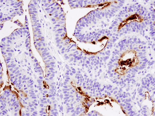 Webinar - Validation of a Glycosylation-Independent Antibody Against the Cancer Stem Cell Marker CD133