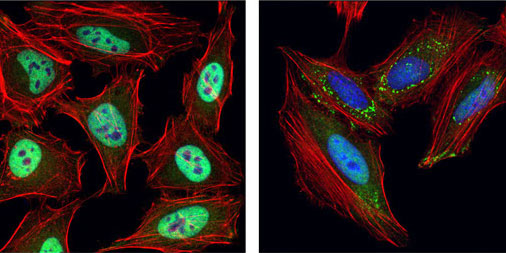 Stress Granules and Neurodegenerative Diseases