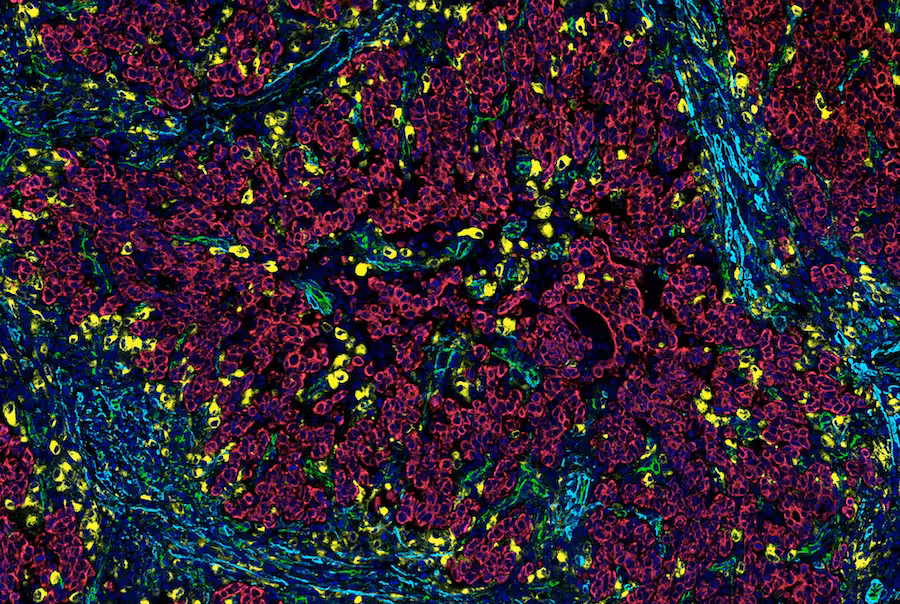  SignalStar multiplex IHC staining to study tumor angiogenesis using antibodies for CD31 (PECAM-1), CD68, Pan-Keratin, and α-Smooth Muscle Actin.