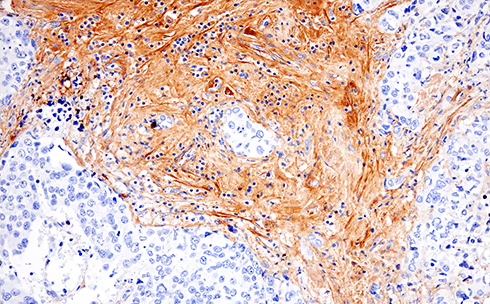 Targeting the Tumor Microenvironment: Key Markers of the ECM