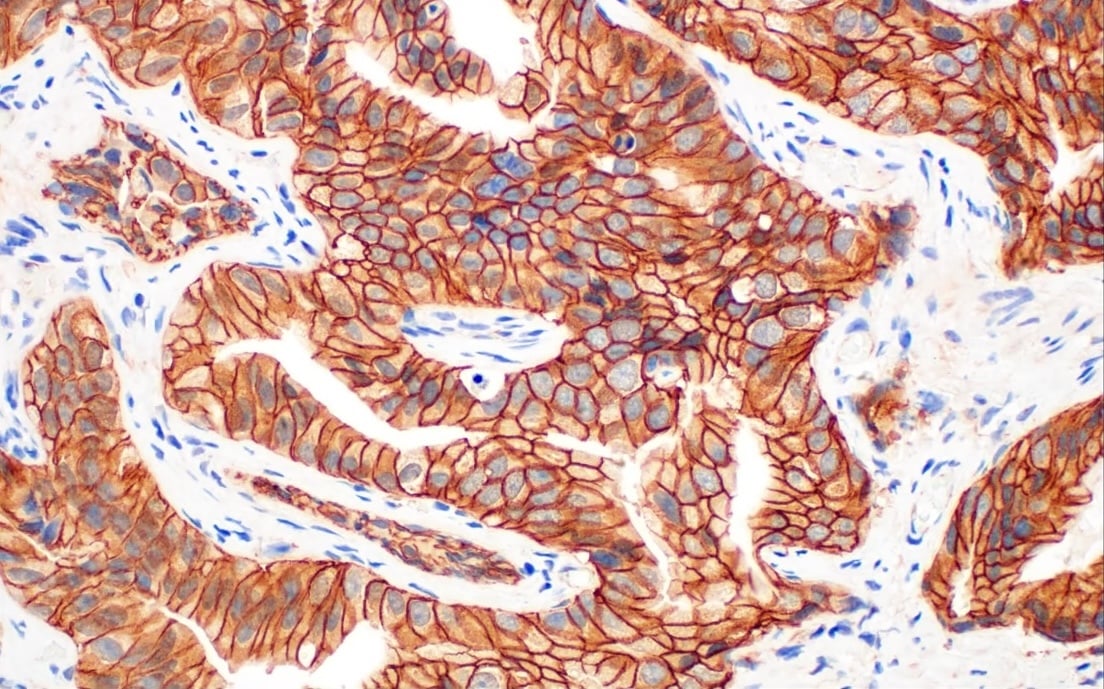 Key Epithelial-Mesenchymal Transition (EMT) Markers in Cancer