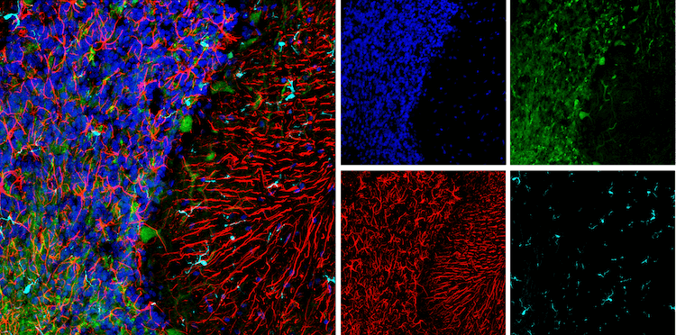 Top 10 Biomarkers Powering Parkinson’s Disease Research