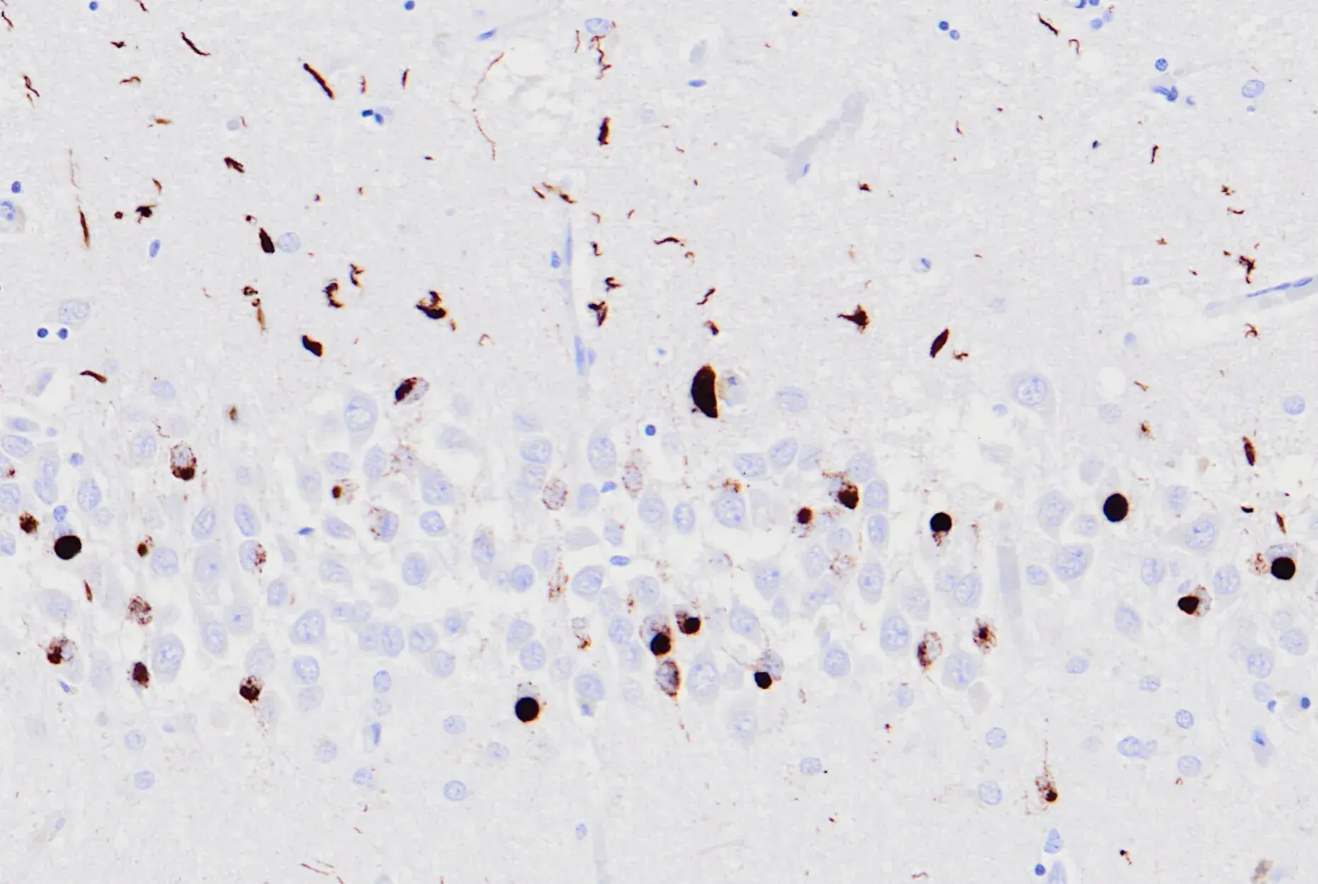 TDP43 in Neurodegeneration: From Mis-Splicing to Neuropathological Change